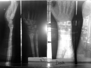 X-rays of my hands from Phonsavan. Not the souvenirs I wanted from my first trip to Laos.